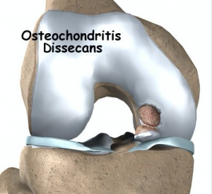 osteocondrite napoli