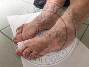 piede diabetico napoli avellino benevento caserta