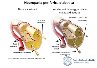 neuropatia