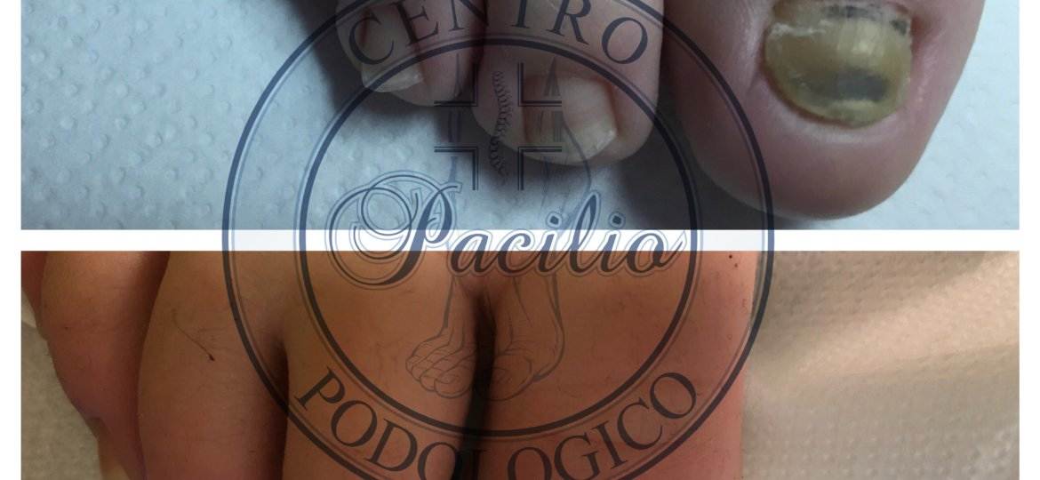 Centro_podologico_Pacilio_Podologo_Posturologo_piede_alluce_micosi_napoli