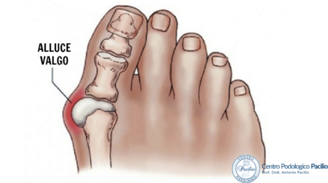 medicazioni-e-bengaggi-post-operatori-alluce-valgo-prof.-pacilio-antonio-podiatra.jpg