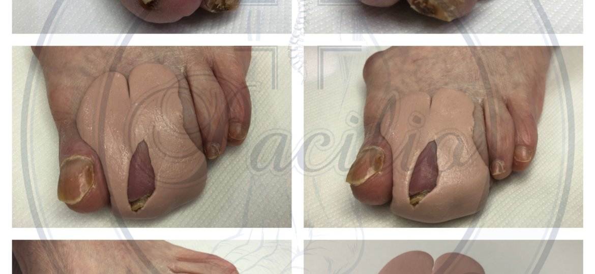 ortesi in silicone piede diabetico