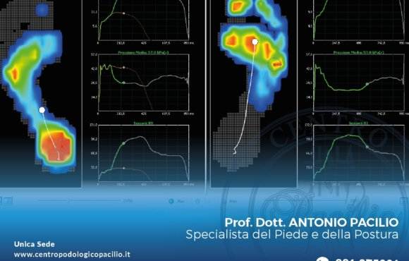 Analisi computerizzata della postura