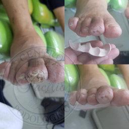 Ortesi podologica in silicone medicale su misura per pregressa ulcerazione a livello apicale del secondo dito del piede