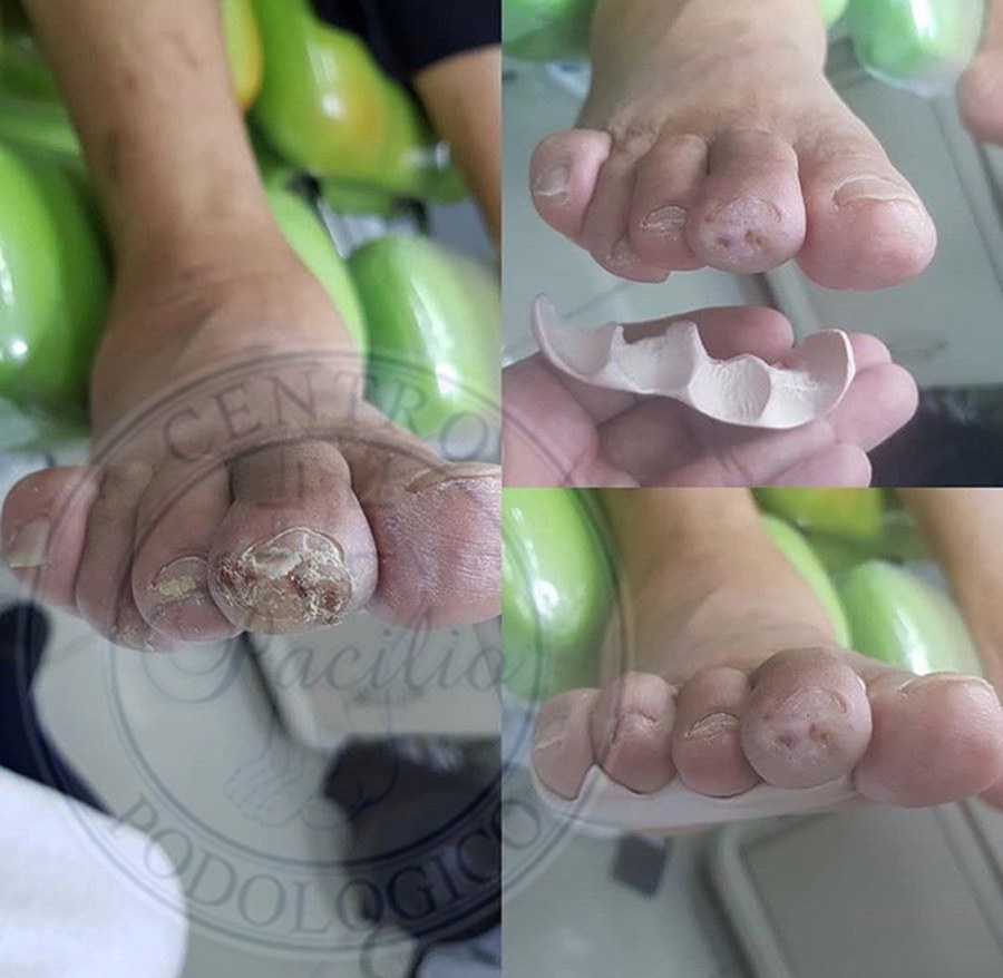 Ortesi podologica in silicone medicale su misura per pregressa ulcerazione a livello apicale del secondo dito del piede