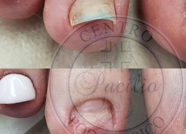 Trattamento Podologico specialistico ed indolore di unghia micotica scollata dal letto ungueale