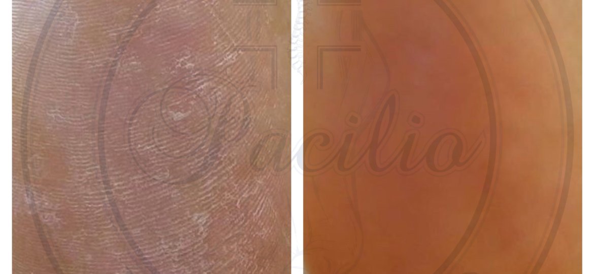 tallone secco napoli