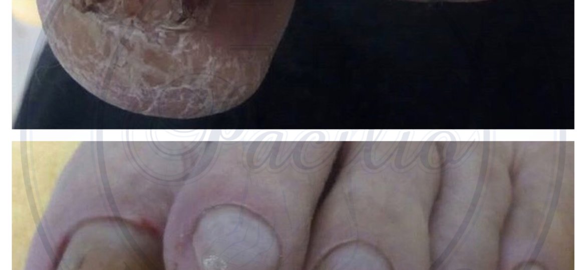 Pre e post trattamento podologico napoli