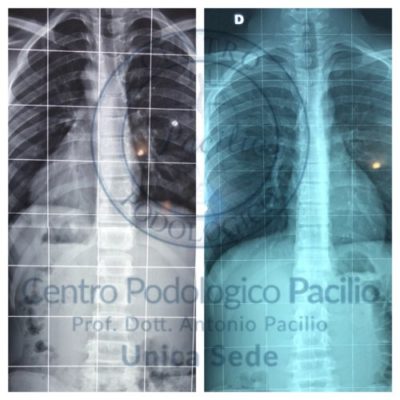 scoliosi e postura napoli
